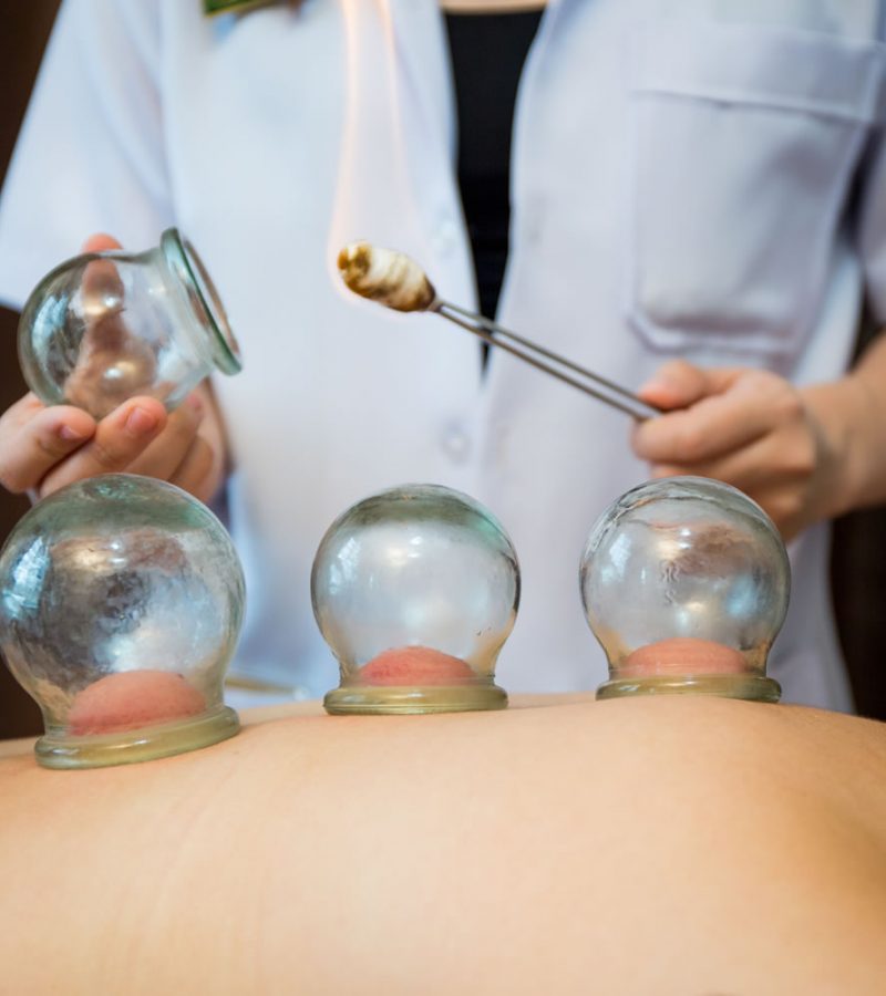 fire-cupping